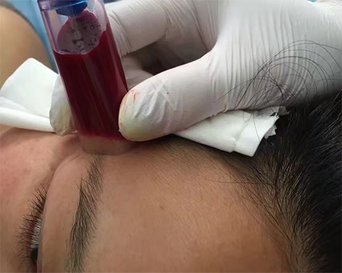 刺血疗法